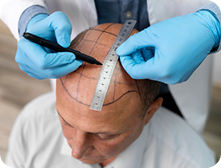 Hair transplants